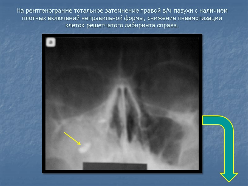 На рентгенограмме тотальное затемнение правой в/ч пазухи с наличием плотных включений неправильной формы, снижение